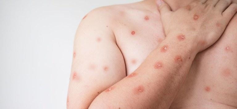 SES alerta para monitoramento de casos de Mpox em MT após avanço de variante em Rondônia
