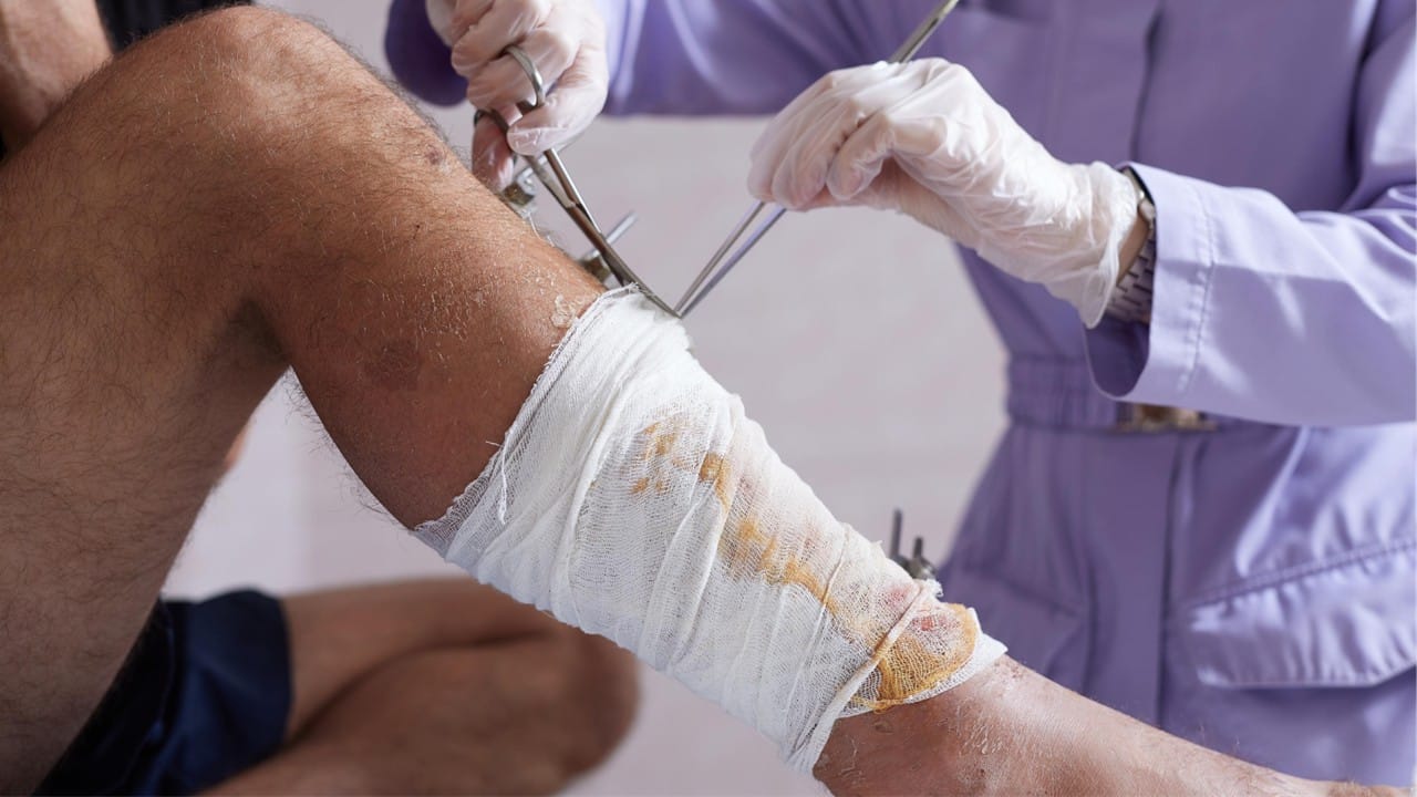 Ambulatório de Feridas da Unimed Cuiabá devolve qualidade de vida a pacientes com lesões crônicas